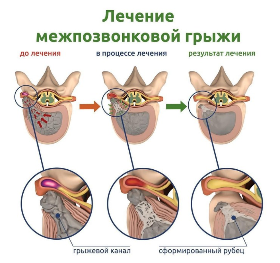 лечение гр.png лечение гр.png